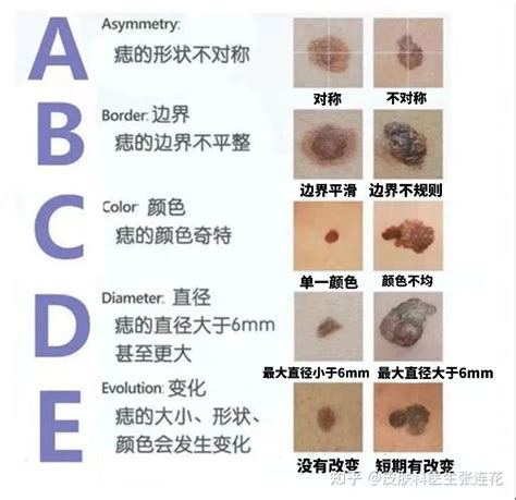 大痣|痣也可能会癌变！长在 3 个地方要注意